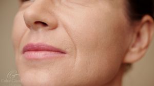 ほうれい線が気になるあなたへ──原因から最新治療法まで徹底解説
