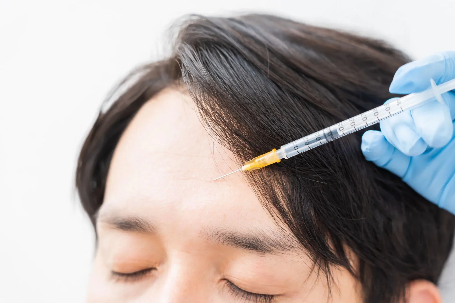 おでこのボトックス注射とは?