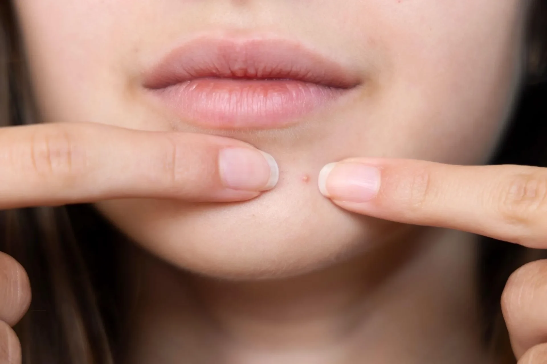 顎ニキビの種類